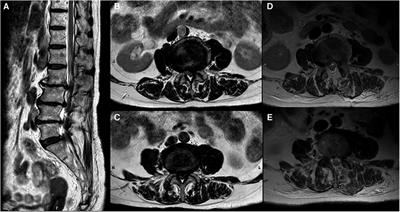 Case Report: Acute common peroneal nerve injury after posterior lumbar decompression surgery